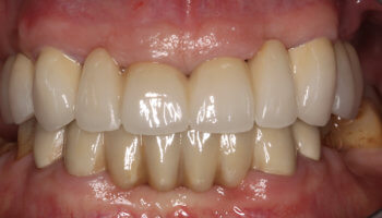 Whitestone Dental - New York - Dr Robert Olan DDS, PC - Periodontics and Dental Implants - Before and After 1