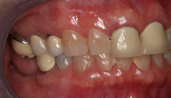 Whitestone Dental - New York - Dr Robert Olan DDS, PC - Periodontics and Dental Implants - Before and After 2