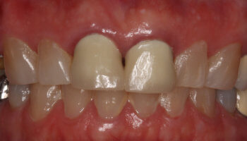 Whitestone Dental - New York - Dr Robert Olan DDS, PC - Periodontics and Dental Implants - Before and After 1