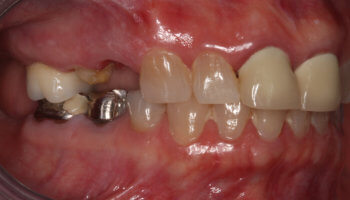 Whitestone Dental - New York - Dr Robert Olan DDS, PC - Periodontics and Dental Implants - Before and After 3